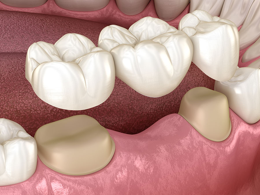 dental bridge model