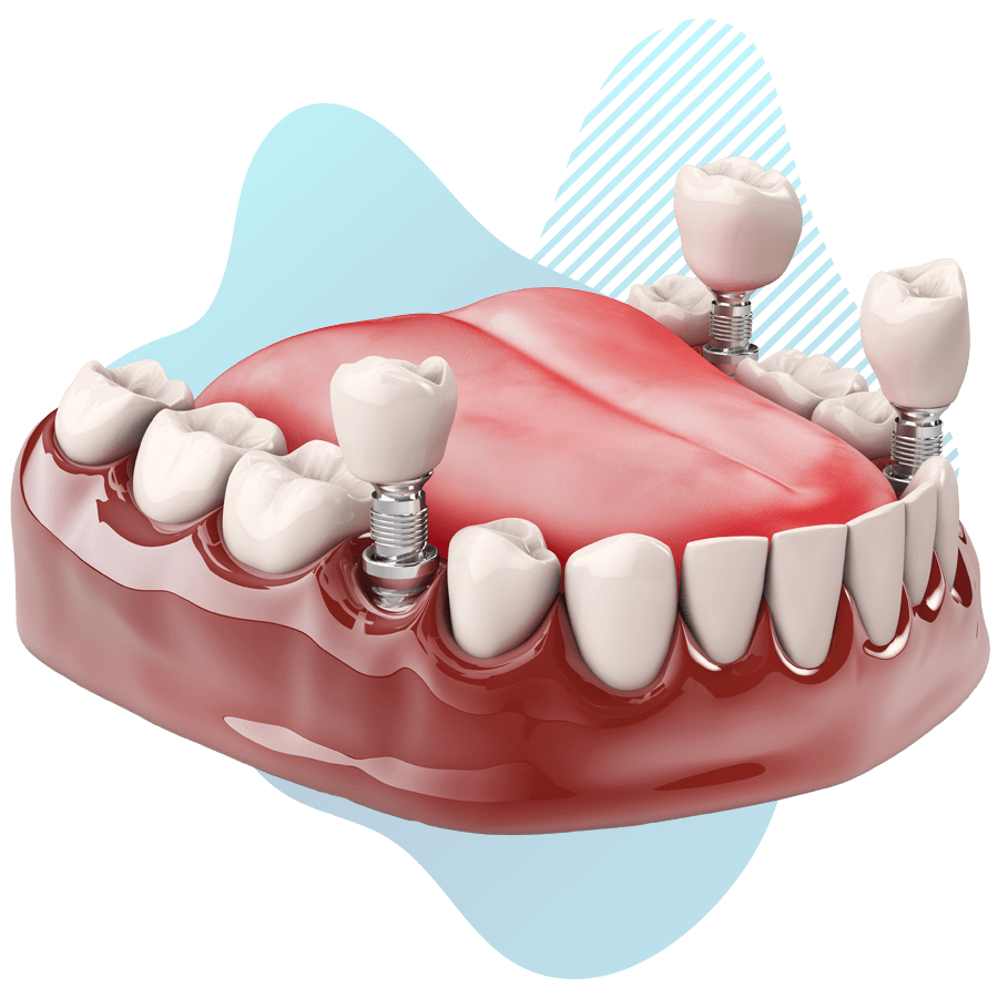 dental implant model