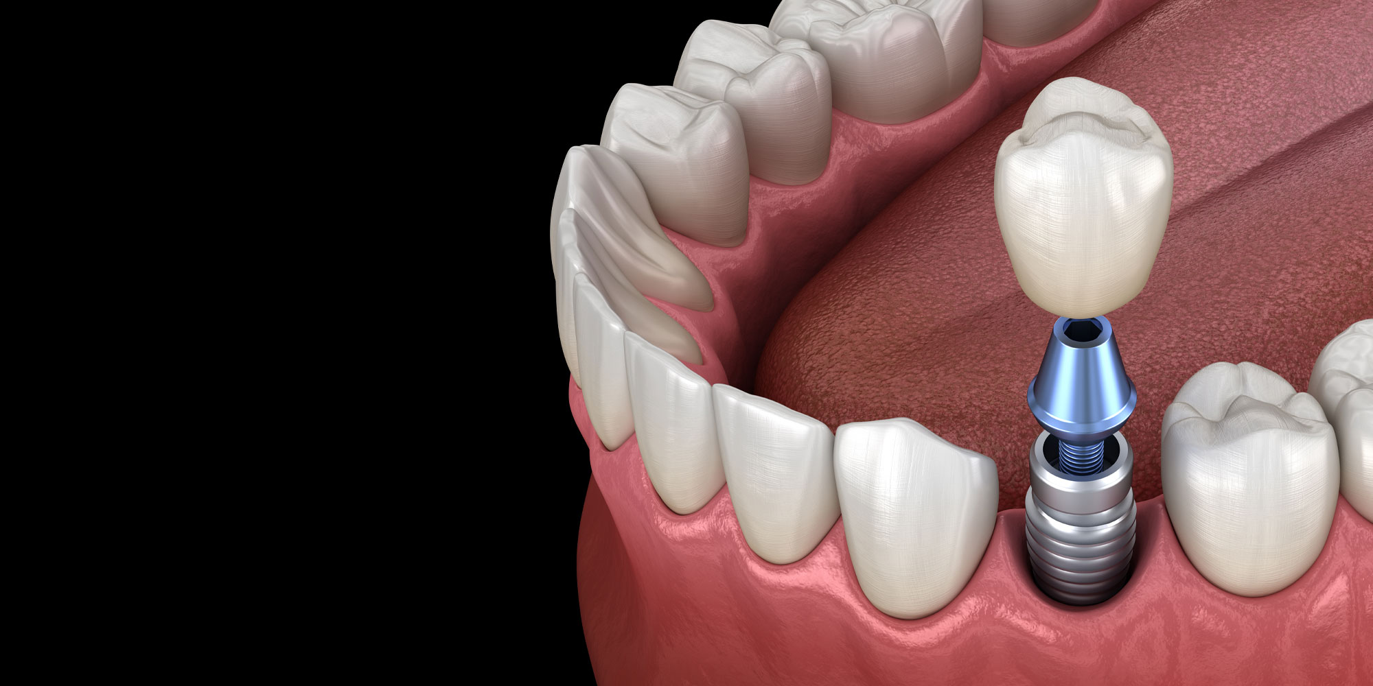 dental implant model