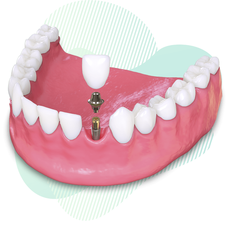 dental implant model