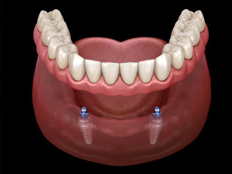 implant supported dentures model