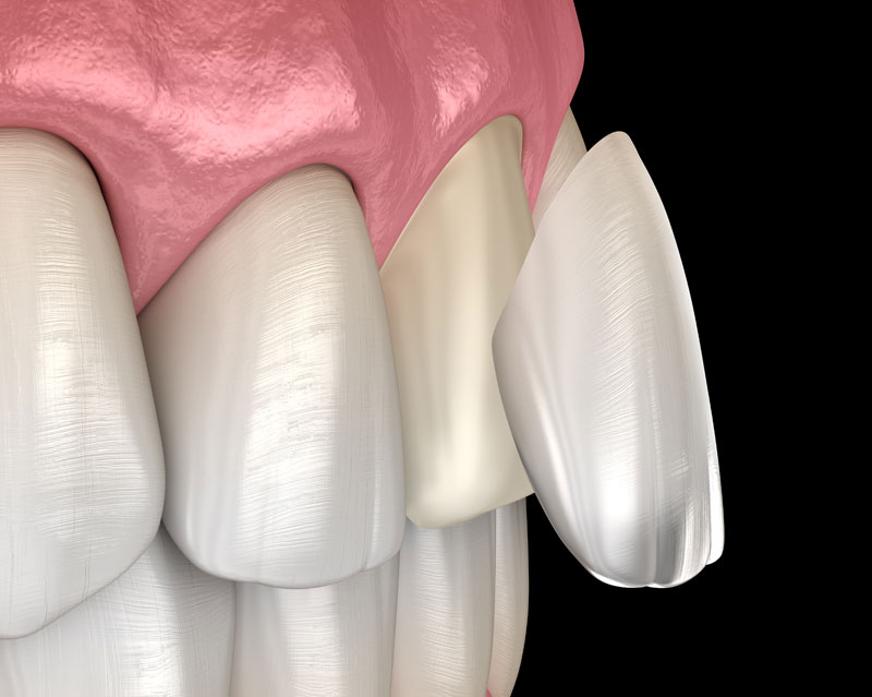 porcelain veneers graphic