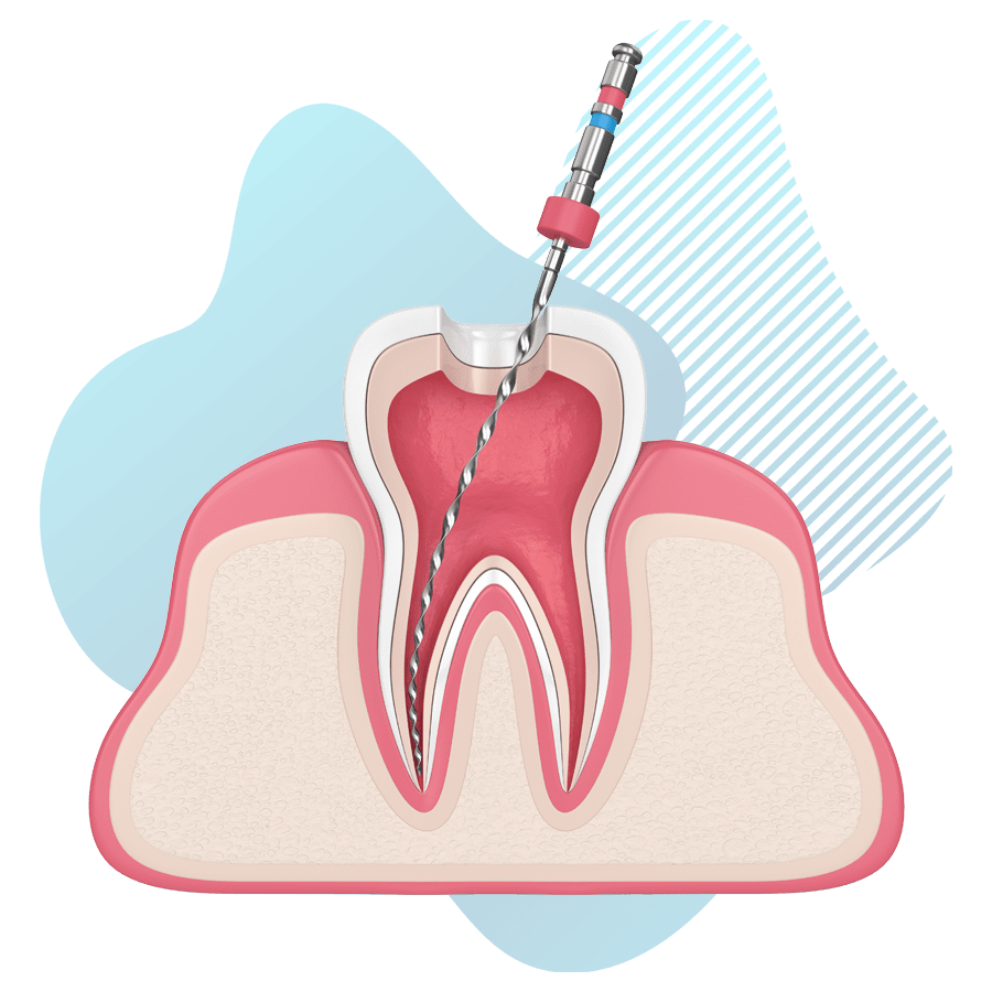When do you need a root canal? | Best Dental